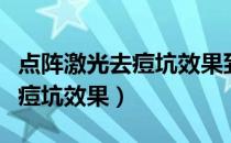 点阵激光去痘坑效果到底怎么样（点阵激光去痘坑效果）