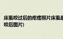 床虱咬过后的疙瘩照片床虱最怕什么怎么消灭(床虱怎么消灭咬后图片)