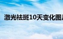 激光祛斑10天变化图片（激光祛斑哪家好）