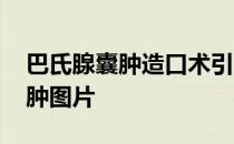 巴氏腺囊肿造口术引流条要放几天 巴氏腺囊肿图片