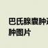 巴氏腺囊肿造口术引流条要放几天 巴氏腺囊肿图片