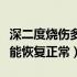 深二度烧伤多久愈合（深二度烧伤疤痕多久才能恢复正常）