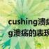 cushing溃疡和curling溃疡怎么读（cushing溃疡的表现）