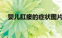 婴儿肛瘘的症状图片（肛瘘的症状图片）